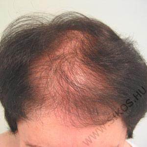 hajátültetés, hajbeültetés női diffúz hajhiány esetén. Műtét előtt