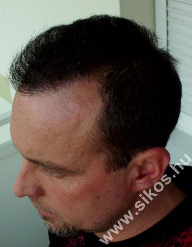Hajbeültetés hajátültetés	Hajbeültetés hajátültetés Hajbeültetés hajátültetés	Hajbeültetés hajátültetés Hajbeültetés hajátültetés	Hajbeültetés hajátültetés