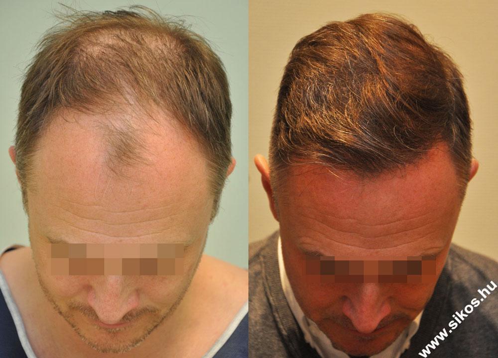 Hair transplant expert in Budapest, Hungary, 